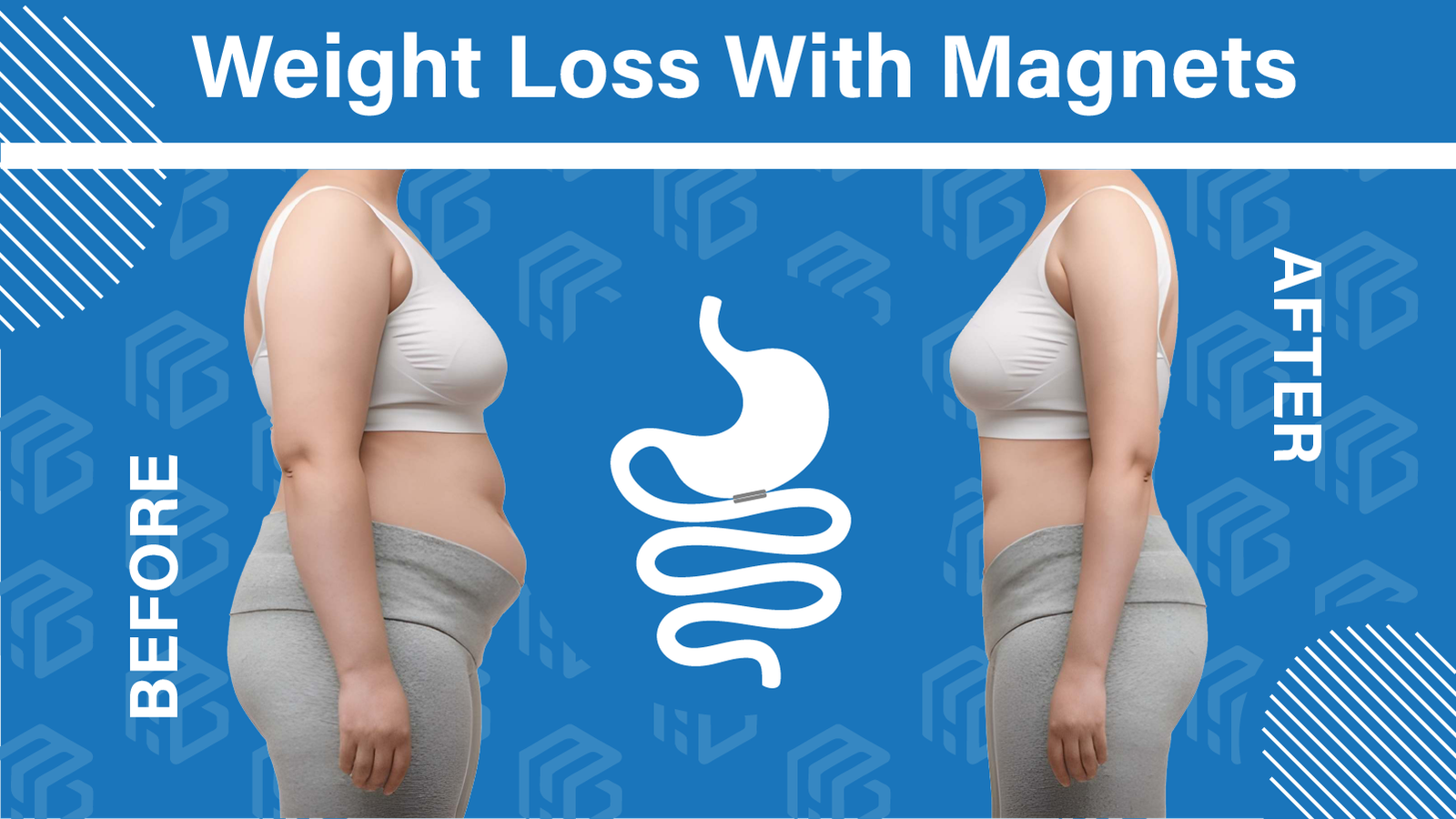 weight loss with magnet -before-after